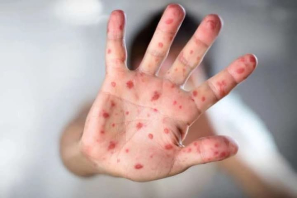 У гімназії Дніпра зафіксовано спалах кору: захворіли троє дітей з одного класу